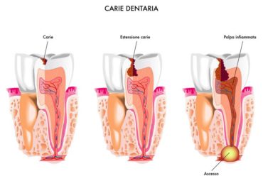 La carie: un nemico silenzioso da combattere al meglio